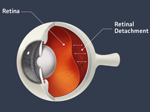 What is Retinal Detachment