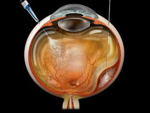 Retinal injections, Assil Gaur Eye Institute