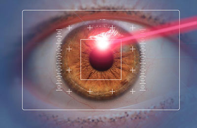 LASIK laser surgery recovery timeline